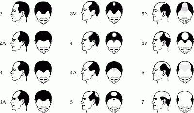 Hudson's Guide: Hair Loss Information and Treatment Options