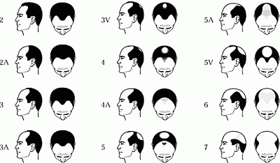 Hudson's Guide: Hair Loss Information and Treatment Options Hudson's Guide: Hair Loss Information and Treatment Options